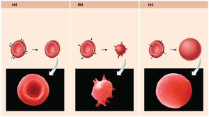 Effect of isotonic, hypertonic, and hypotonic solutions on red blood cells