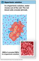 Hypertonic solution and crenated red blood cell