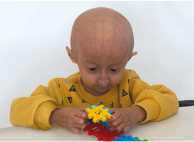 Child with progeria, a disease that mimics accelerated aging
