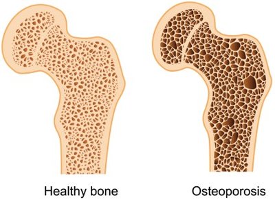 Healthy bone vs. osteoporotic bone