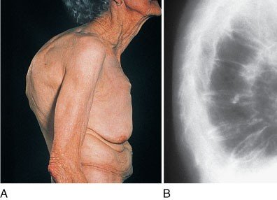 Dowager's hump and X-ray in osteoporosis
