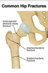 Common hip fractures in osteoporosis