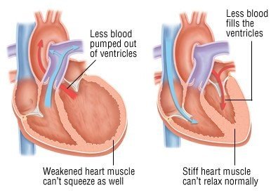 Diagram showing heart failure as a result of homeostatic imbalance