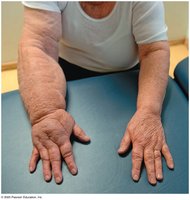 Lymphedema in the arm of a breast cancer patient