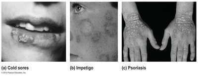 Images of cold sores, impetigo, and psoriasis