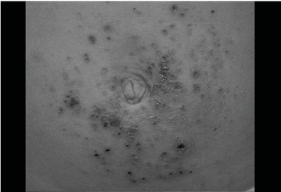 Contact dermatitis on the skin