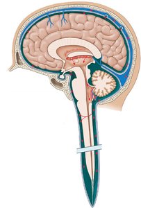 Diagram of CSF reabsorption at the superior sagittal sinus