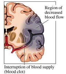Diagram of epidural and subdural hematomas