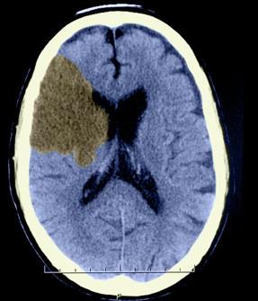 CT scan showing subdural hematoma