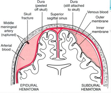 Diagram of a stroke showing region of decreased blood flow