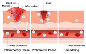 Diagram of wound healing phases: inflammatory, proliferative, and remodeling