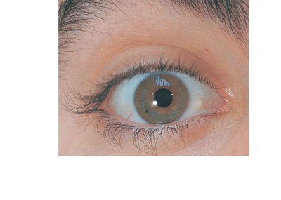 Surface anatomy of the right eye