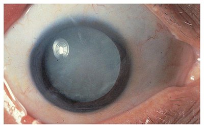 Cataract in the eye
