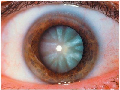 Photograph of a cataract