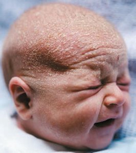 Cradle cap (seborrhea) in a newborn