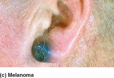Melanoma