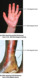 Partial-thickness and full-thickness burns