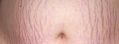 Stretch marks (striae) on the abdomen