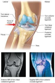 Knee injury: unhappy triad with MRI images