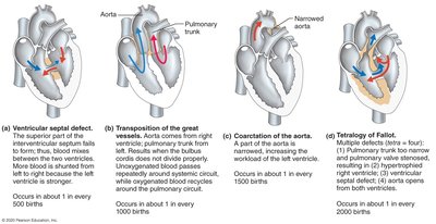 Congenital heart defects