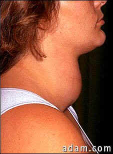 Goiter due to hypothyroidism