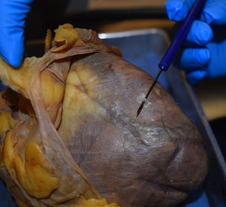 Dissection showing the parietal pericardium and epicardium