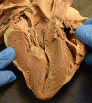 Chordae tendineae, bicuspid valve, and papillary muscle