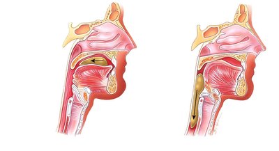 Swallowing mechanism: oral, pharyngeal, and esophageal phases