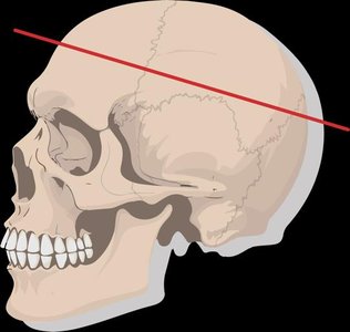 Facial bones of the skull color-coded