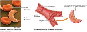 Sickle-cell disease erythrocytes