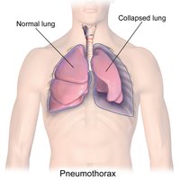 Normal and collapsed lung in pneumothorax
