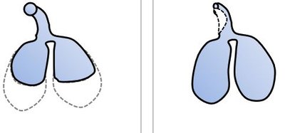 Spirograms for normal, asthma, emphysema, and fibrosis lungs