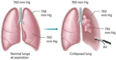 Normal lung vs. collapsed lung due to pneumothorax