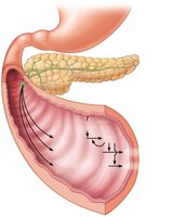 Activation of pancreatic proteases in the small intestine