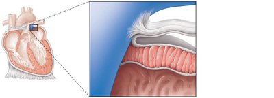 Heart wall and coverings