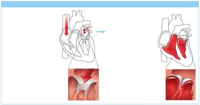 Operation of the AV valves