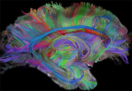 DTI image showing neural circuits in the brain