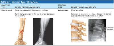 Common types of fractures 1