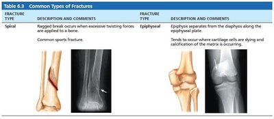 Common types of fractures 2