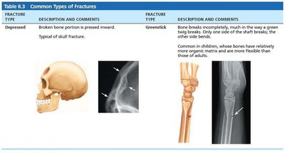 Common types of fractures 3