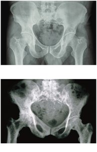 Paget's disease bone appearance
