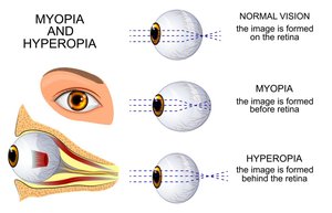 Myopia and Hyperopia Diagram