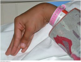 Carpopedal spasm of hypocalcemia