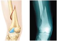 Spiral fracture