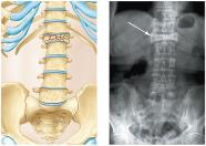 Compression fracture