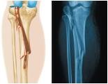 Comminuted fracture
