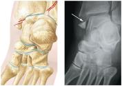 Avulsion fracture