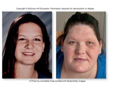 Acromegaly due to excess growth hormone