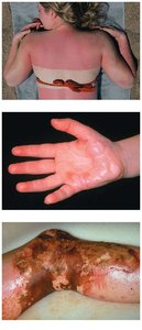Examples of burns