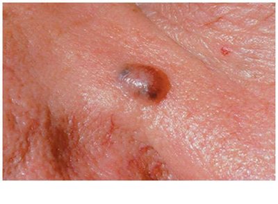 Basal cell carcinoma